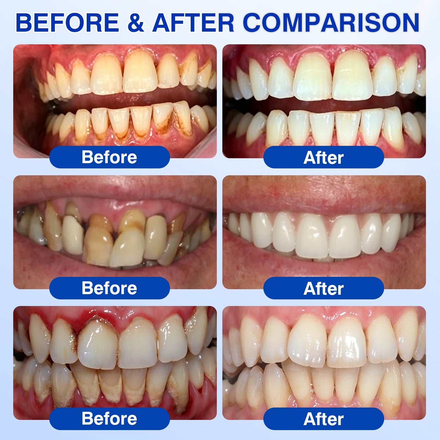 CA🦷😘NATRAVOR® GumCare Pro Advanced Gum Care Gel