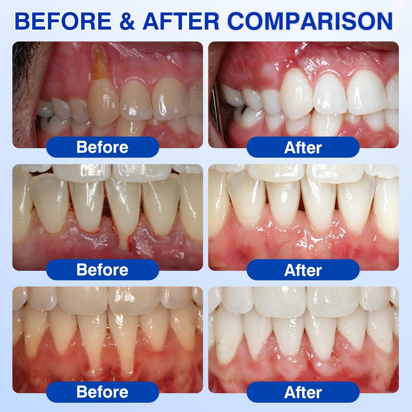 CA🦷😘NATRAVOR® GumCare Pro Advanced Gum Care Gel